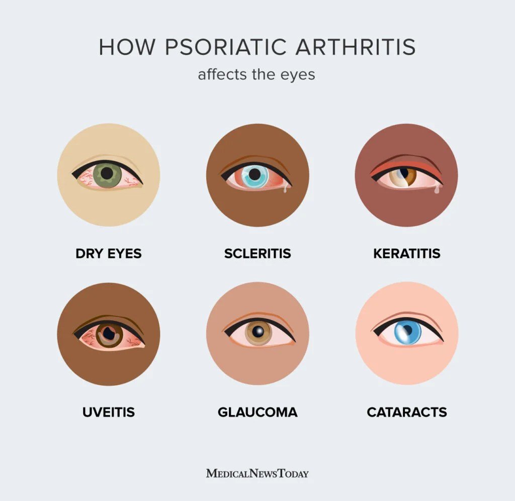 Infografica che mostra gli effetti dell'artrite psoriasica sugli occhi