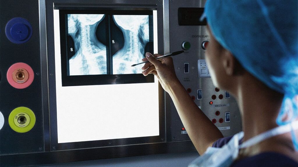 Un chirurgien examine une radiographie fixée sur une table lumineuse à la recherche de signes de mésothéliome pleural.